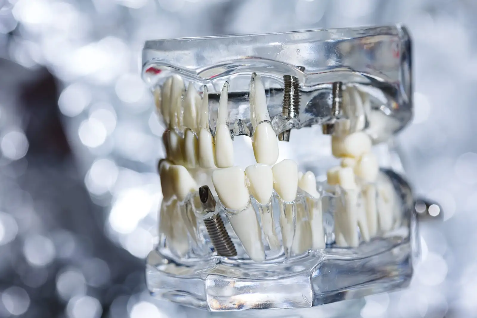 All-on-6 Turkey full-arch fixed zirconia bridge with independent partner dentists in Istanbul