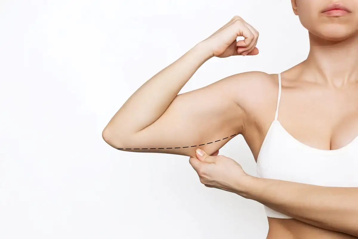 Intervento di rimodellamento del corpo con lifting delle braccia (brachioplastica) in Turchia coordinato da Luna Clinic Medical Travel Services