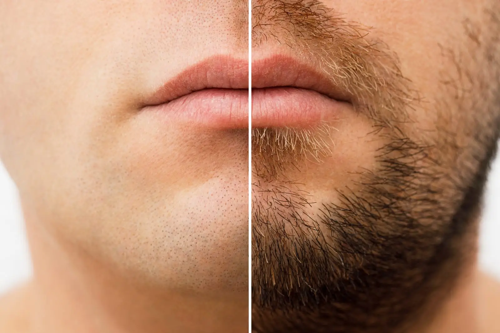 Beard Transplant Turkey, with independent partner specialists in Istanbul