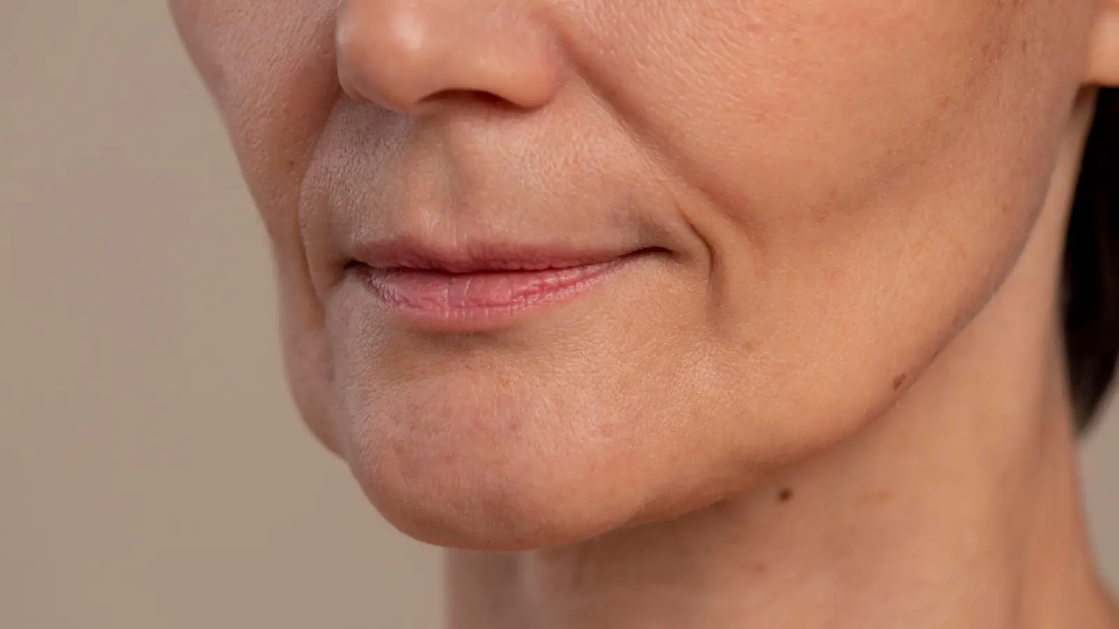 Primer plano del tercio inferior del rostro de una mujer, con el surco nasogeniano marcado tras la pérdida de volumen facial