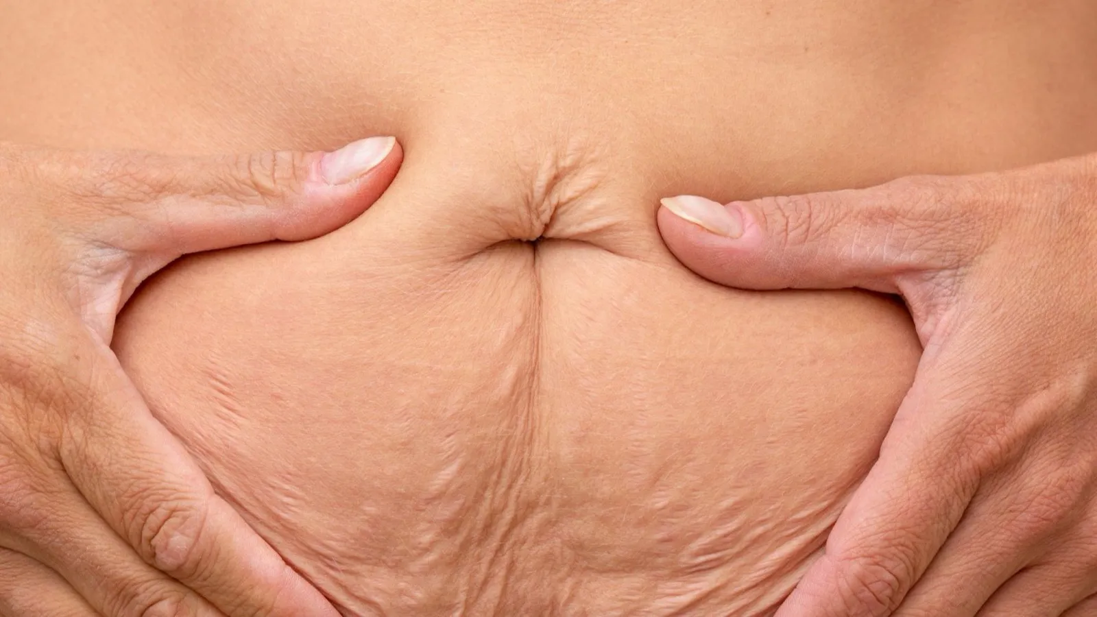 Mâinile unei femei cuprind pielea lăsată a abdomenului, cu vergeturi, după o slăbire importantă