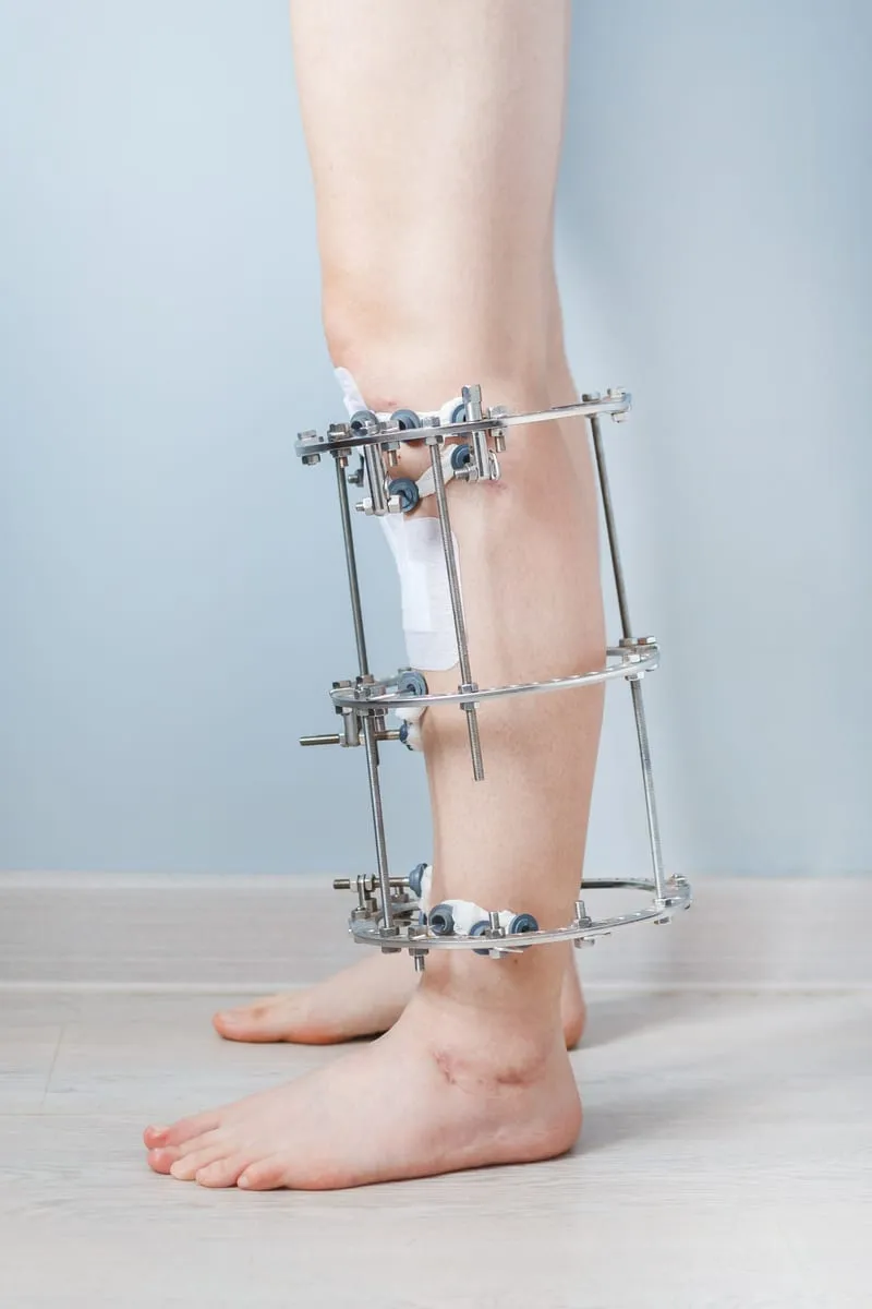 Limb lengthening surgery cost in Turkey