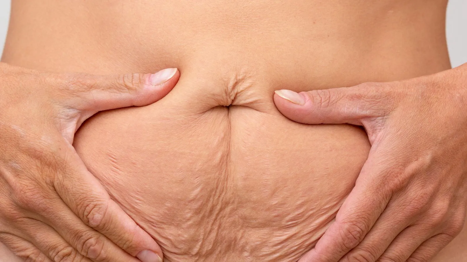 A woman’s hands framing the loose skin and stretch marks on her abdomen after significant weight loss