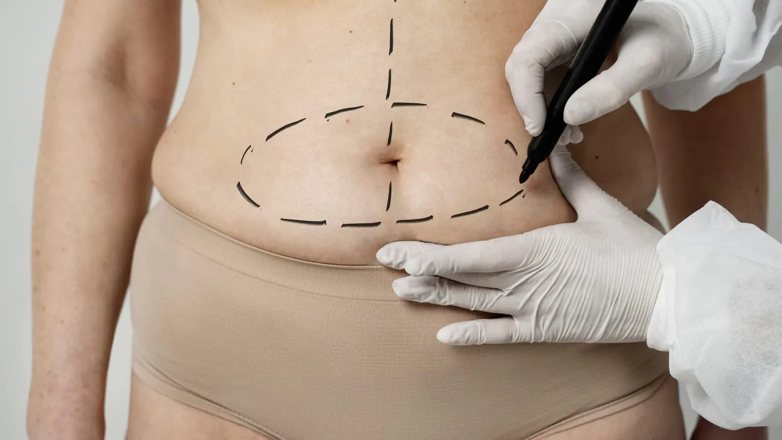 Mommy Makeover in der Türkei: Ratgeber zu Kosten, Ablauf und Erholung
