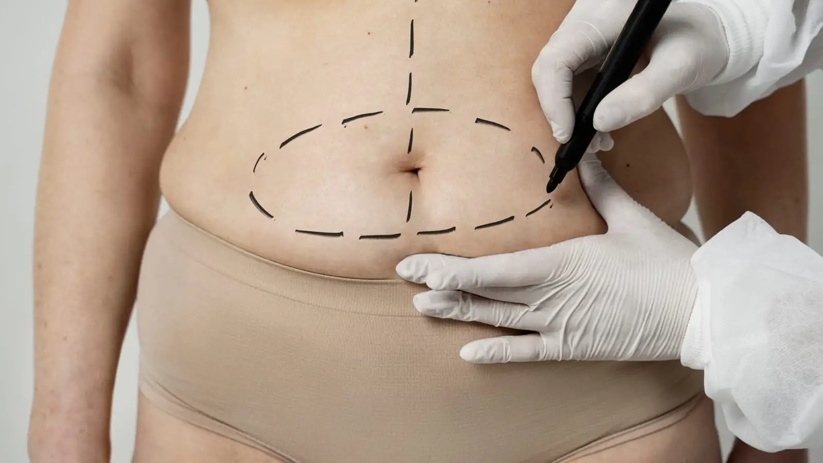 Chirurg markiert den Bauch einer Patientin vor einer Bauchdeckenstraffung als Teil eines Mommy Makeover in der Türkei