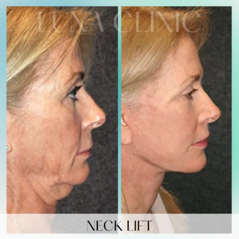 Пример до и после пластической операции от независимого партнёрского хирурга (18)
