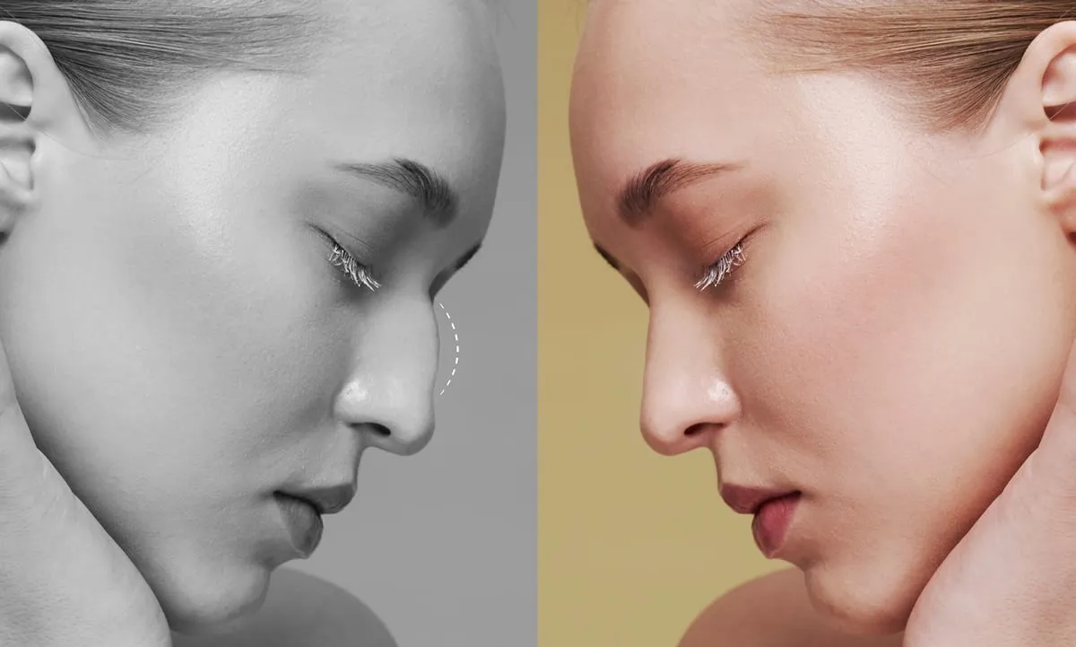Rhinoplasty nose reshaping, before and after profile in Turkey