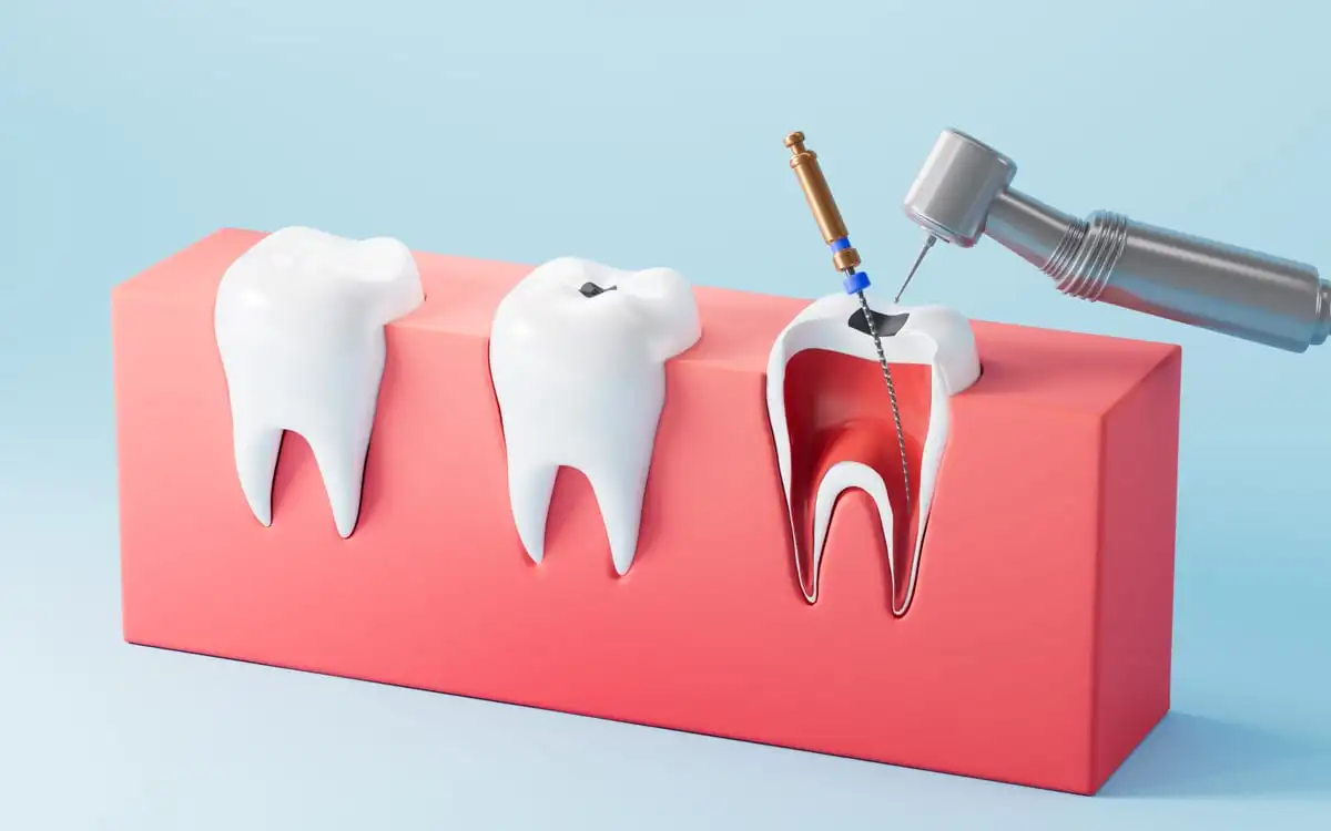 Devitalizzazione in Turchia, paziente con un sorriso naturale e sano dopo un trattamento dentale a Istanbul