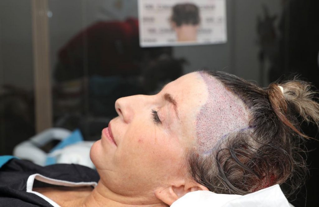 Female hair transplant in Turkey