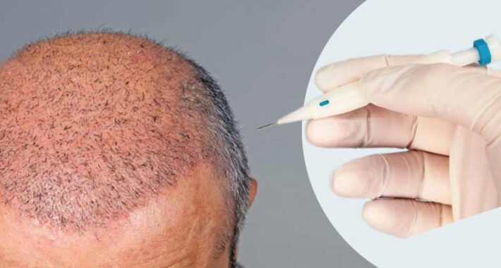 DHI hair transplant in Turkey